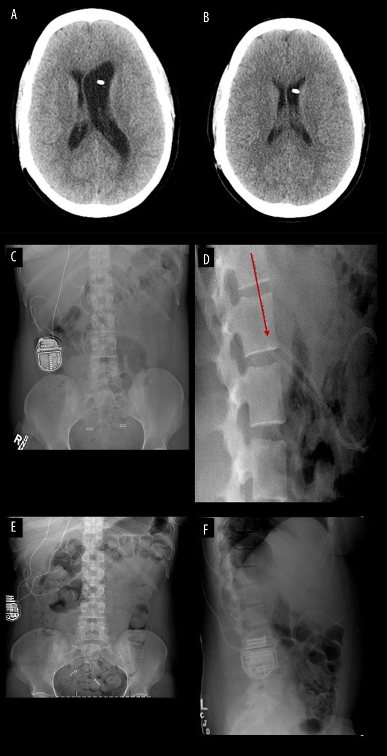 Lumboperitoneal Shunt Placement — Figure 1.