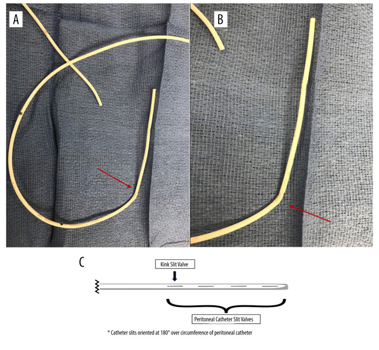 Lumboperitoneal Shunt Placement — Figure 2.