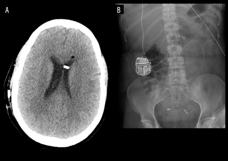 Lumboperitoneal Shunt Placement — Figure 3.