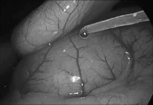 Lumboperitoneal Shunt Placement — Figure 1.