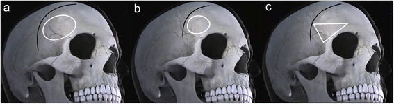 MCA Aneurysm Clipping — Fig. 1