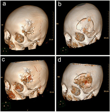 MCA Aneurysm Clipping — Fig. 2