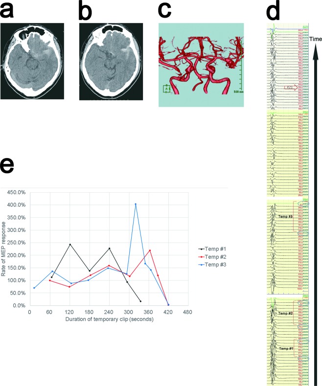 MCA Aneurysm Clipping — Figure 2