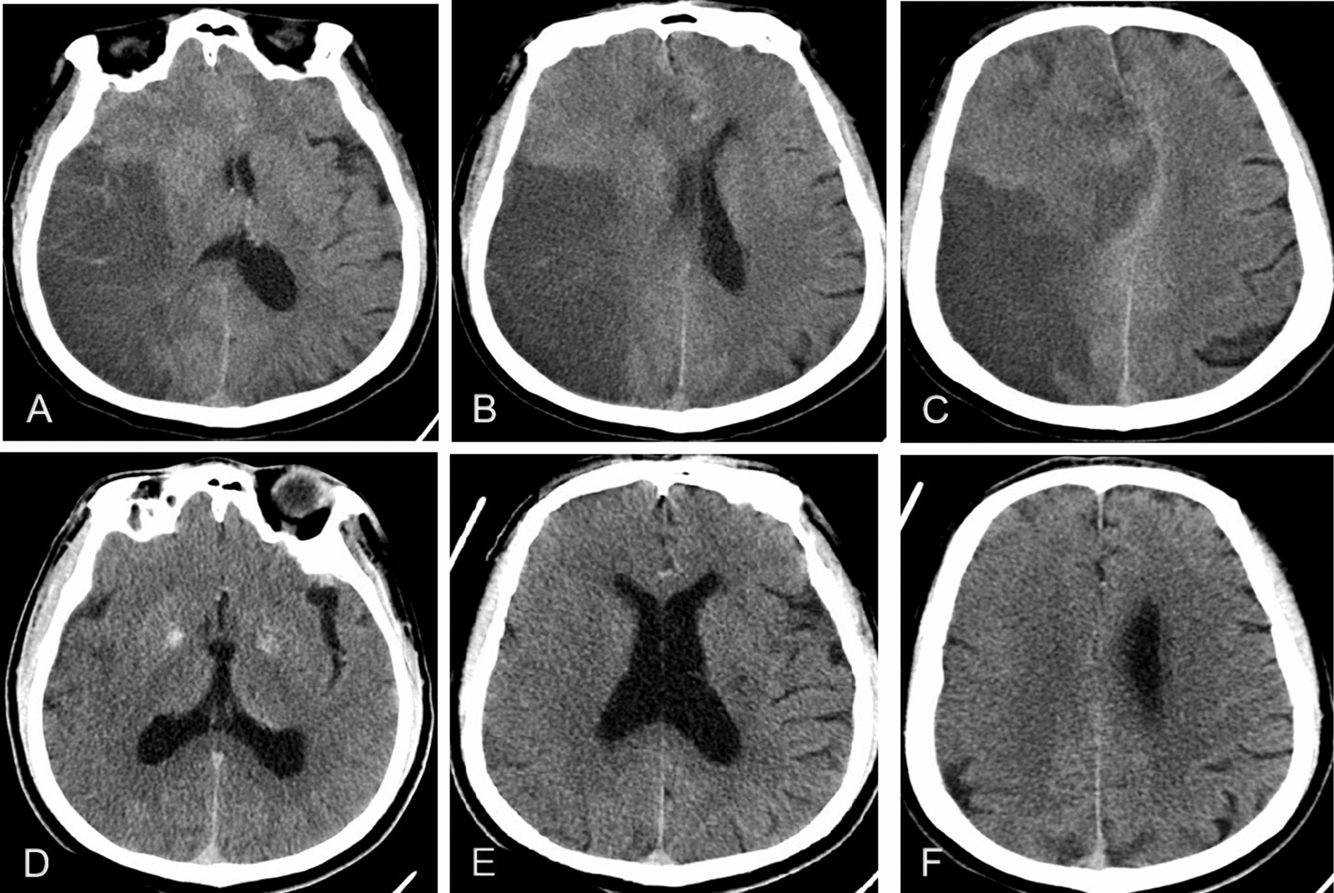 Mechanical Thrombectomy Acute Ischemic Stroke — Fig. 2