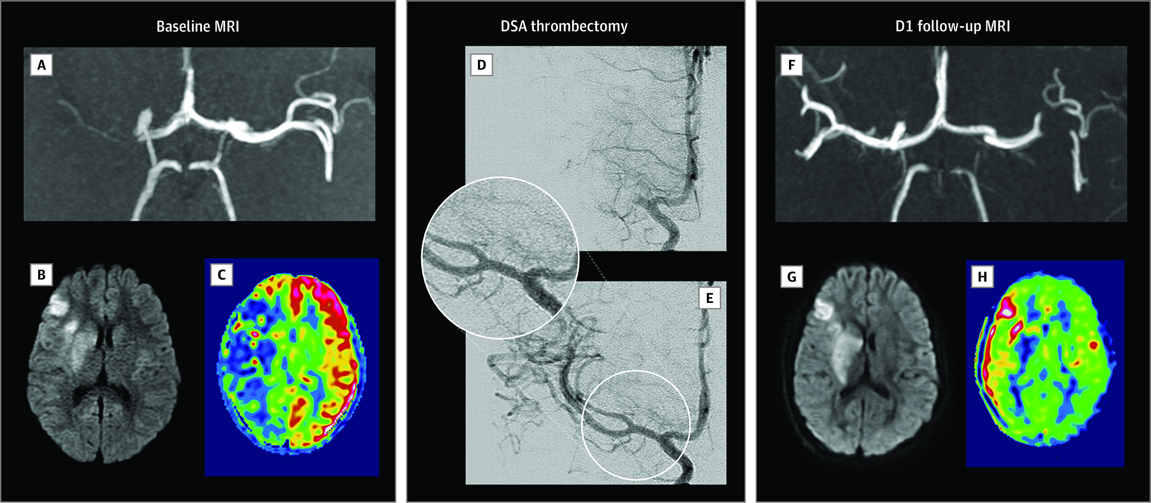 Mechanical Thrombectomy Acute Ischemic Stroke — Figure 1.