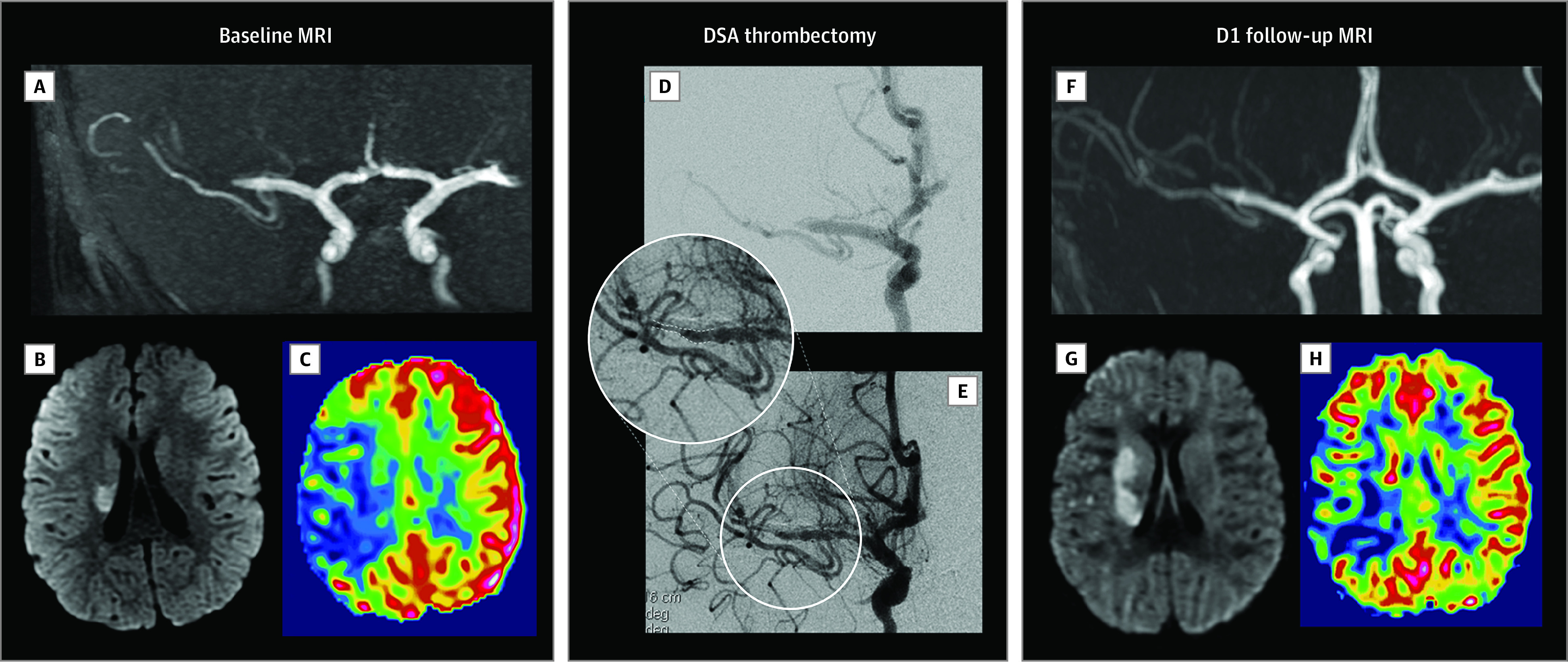 Mechanical Thrombectomy Acute Ischemic Stroke — Figure 2.