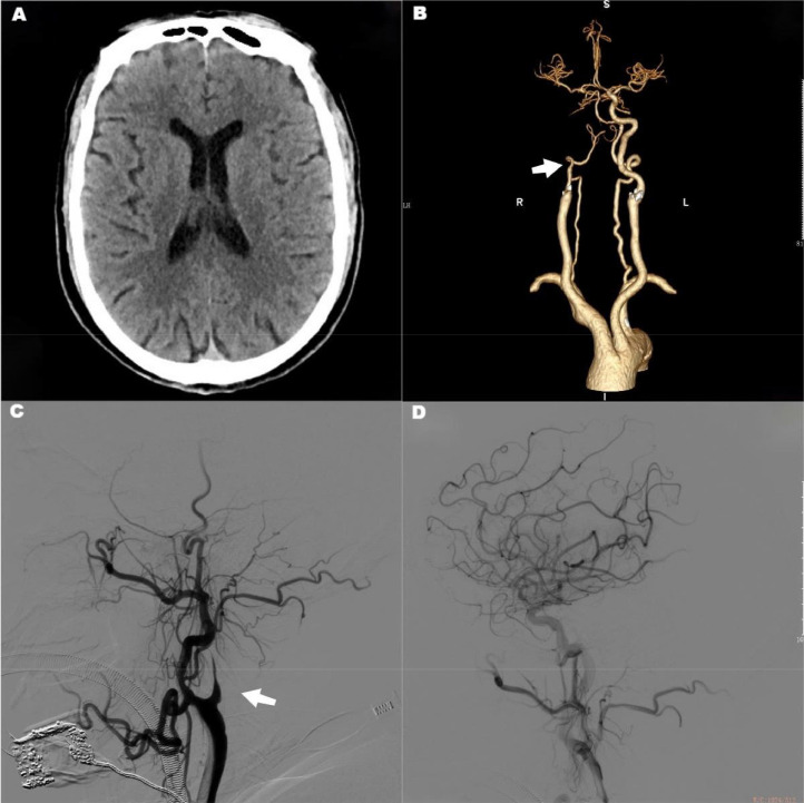 Mechanical Thrombectomy Acute Ischemic Stroke — Fig. 1