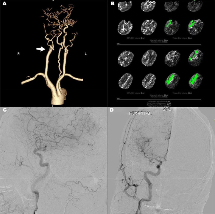 Mechanical Thrombectomy Acute Ischemic Stroke — Fig. 2