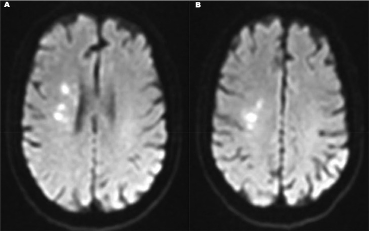Mechanical Thrombectomy Acute Ischemic Stroke — Fig. 3