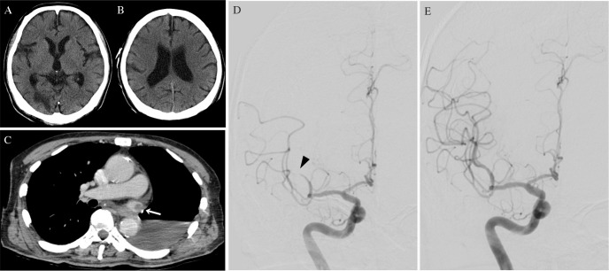 Mechanical Thrombectomy Acute Ischemic Stroke — Fig. 1
