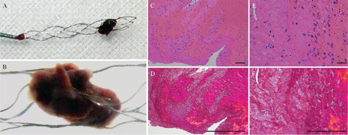 Mechanical Thrombectomy Acute Ischemic Stroke — Fig. 2