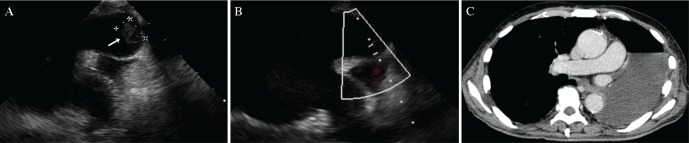 Mechanical Thrombectomy Acute Ischemic Stroke — Fig. 3