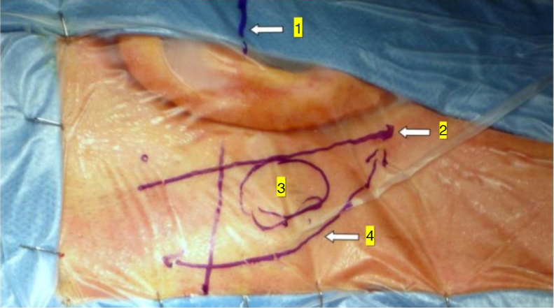Microvascular Decompression Hemifacial Spasm — Figure 1
