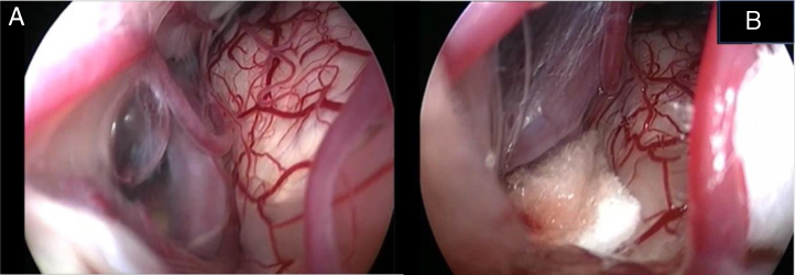 Microvascular Decompression Hemifacial Spasm — Figure 2