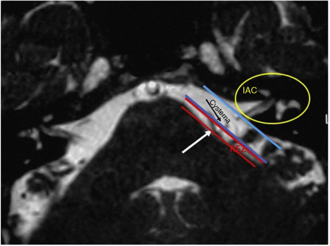Microvascular Decompression Hemifacial Spasm — Figure 6