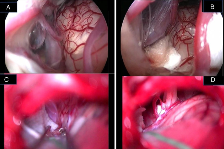 Microvascular Decompression Hemifacial Spasm — Figure 7