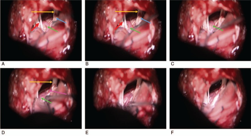 Microvascular Decompression Hemifacial Spasm — Figure 1