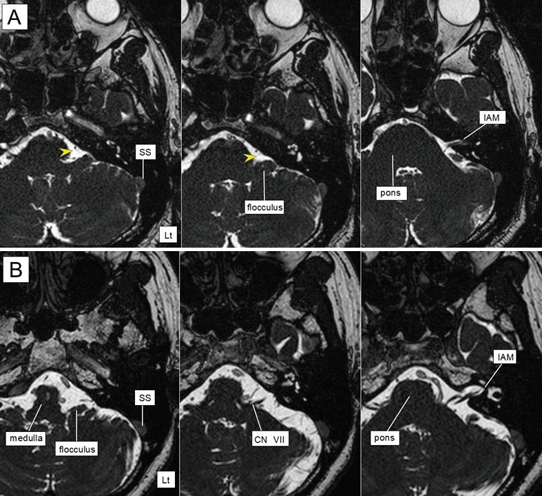 Microvascular Decompression Hemifacial Spasm — Fig. 1