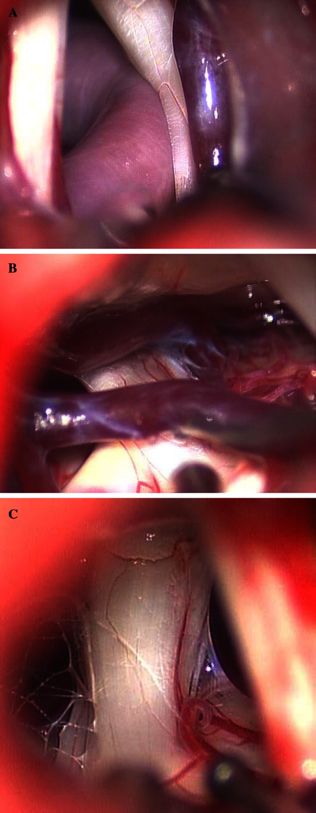 Microvascular Decompression Trigeminal Neuralgia — Fig. 1