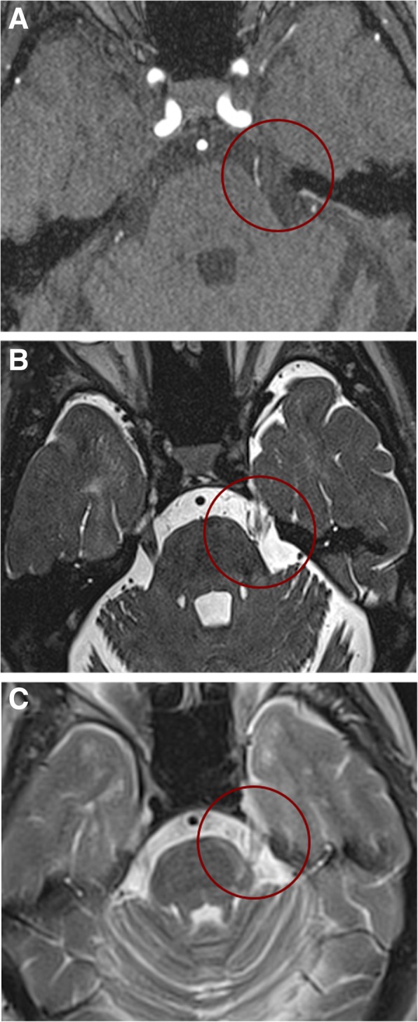 Microvascular Decompression Trigeminal Neuralgia — Fig. 1
