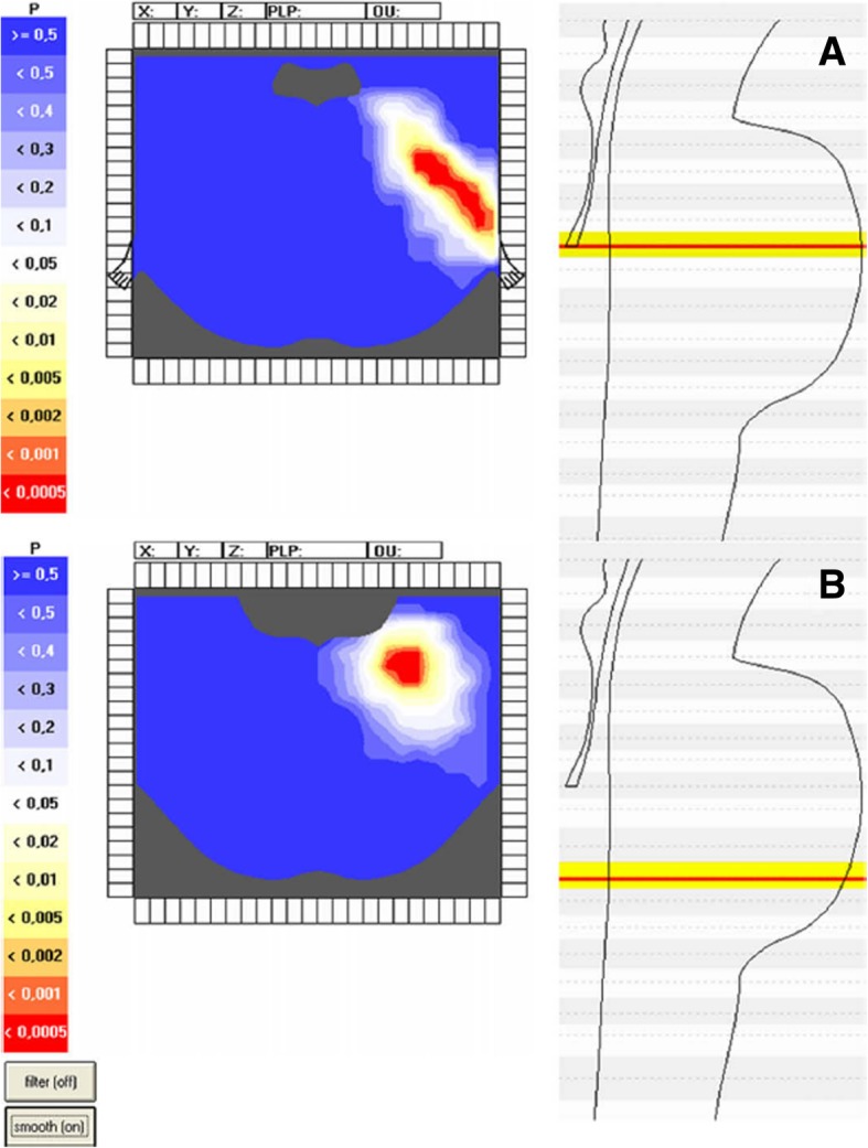 Microvascular Decompression Trigeminal Neuralgia — Fig. 2