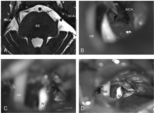 Microvascular Decompression Trigeminal Neuralgia — Figure 1