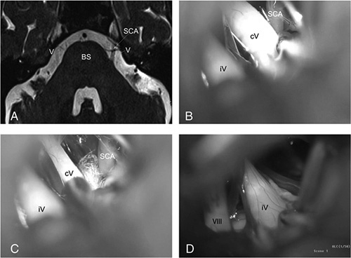 Microvascular Decompression Trigeminal Neuralgia — Figure 2
