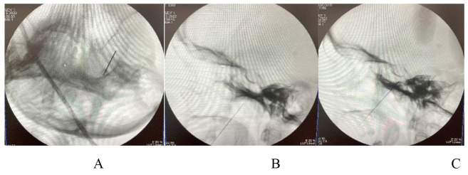 Microvascular Decompression Trigeminal Neuralgia — Figure 1