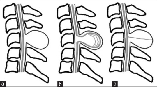 Myelomeningocele Repair — Figure 1