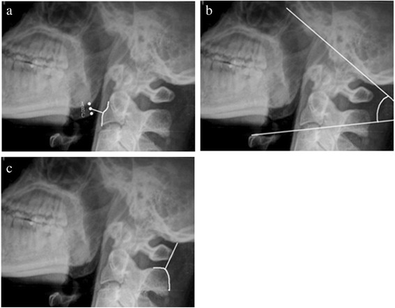Occipitocervical Fusion — Figure 1