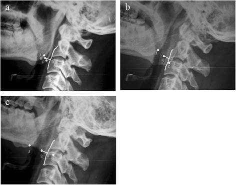 Occipitocervical Fusion — Figure 2