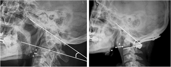Occipitocervical Fusion — Figure 3