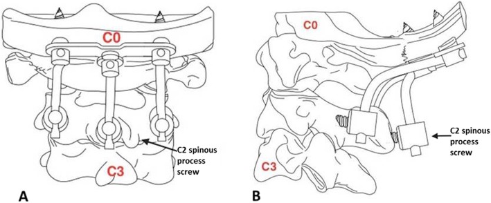 Occipitocervical Fusion — Fig. 1