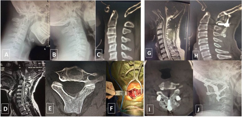 Occipitocervical Fusion — Fig. 2