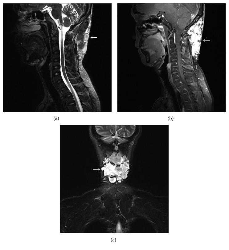 Occipitocervical Fusion — Figure 1