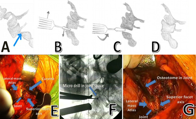 Odontoid Fracture Fixation — FIG. 1.