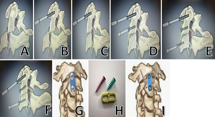 Odontoid Fracture Fixation — FIG. 2.