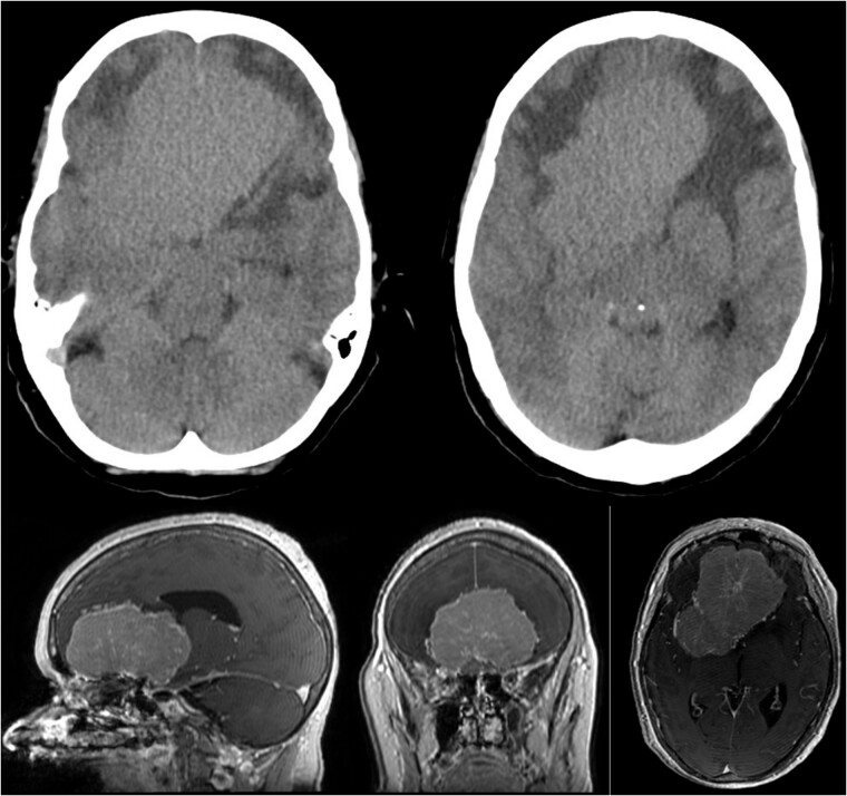 Olfactory Groove Meningioma Resection — Figure 1