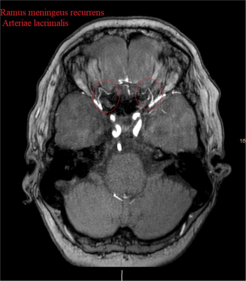 Olfactory Groove Meningioma Resection — Figure 2