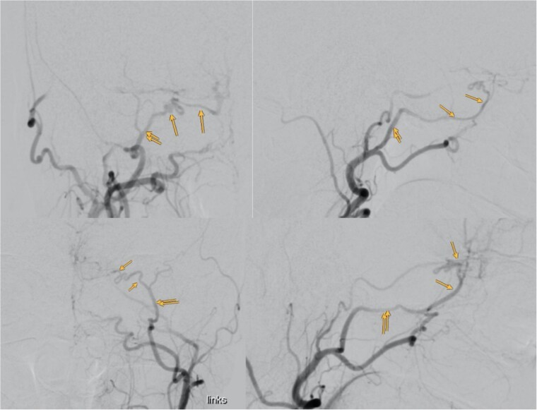 Olfactory Groove Meningioma Resection — Figure 3
