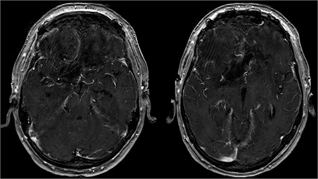 Olfactory Groove Meningioma Resection — Figure 4