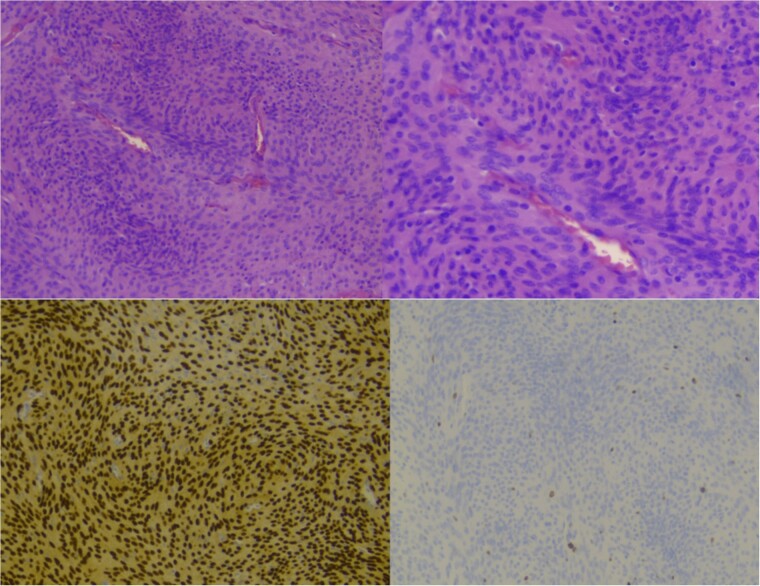 Olfactory Groove Meningioma Resection — Figure 5