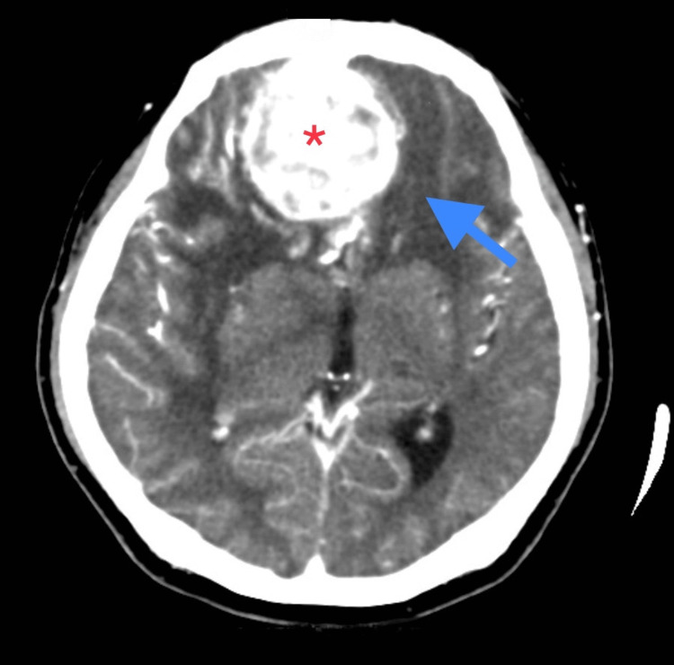 Olfactory Groove Meningioma Resection — Figure 1