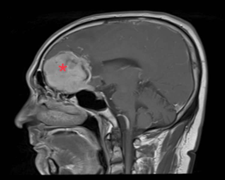 Olfactory Groove Meningioma Resection — Figure 2