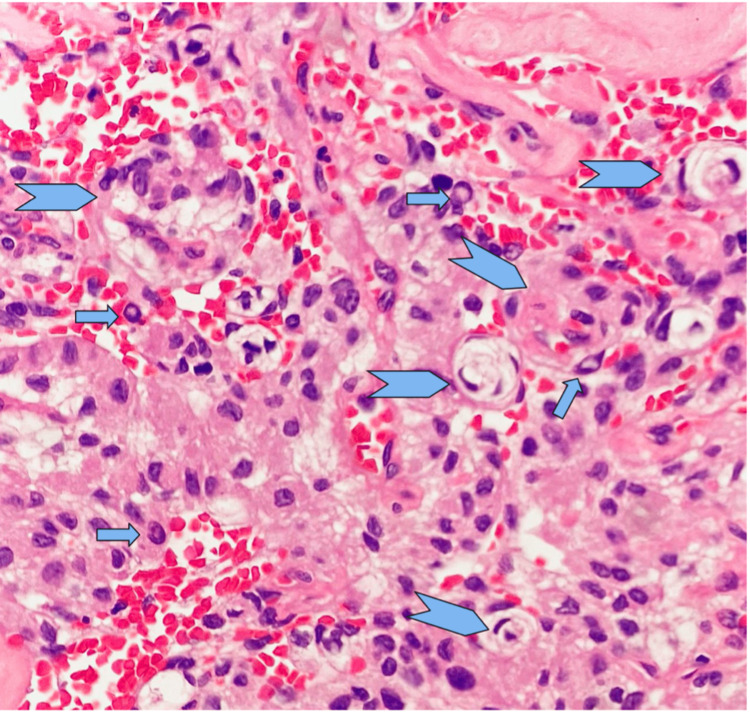 Olfactory Groove Meningioma Resection — Figure 3