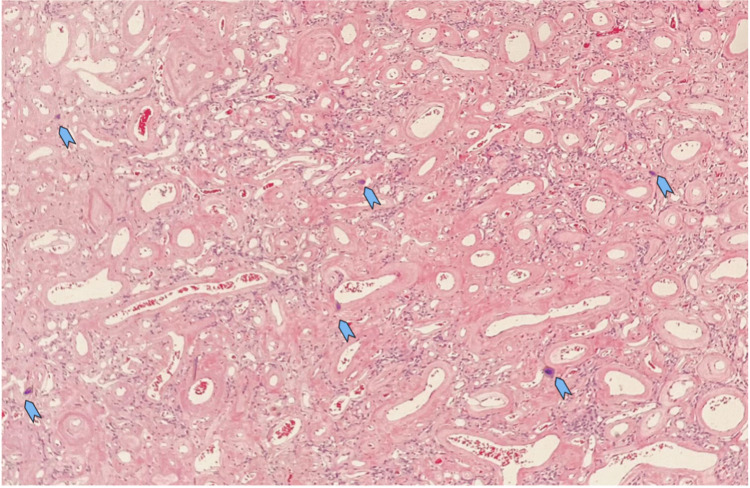 Olfactory Groove Meningioma Resection — Figure 4