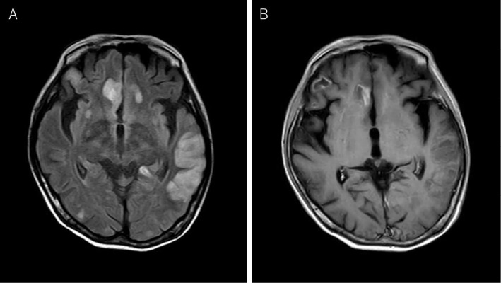Open Brain Biopsy — Figure 1.