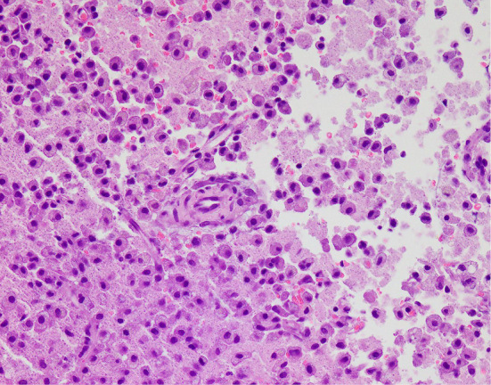 Open Brain Biopsy — Figure 2.