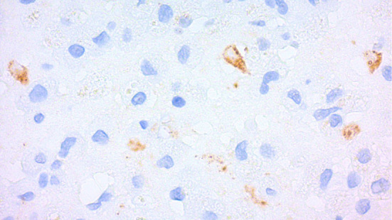 Open Brain Biopsy — Figure 3.