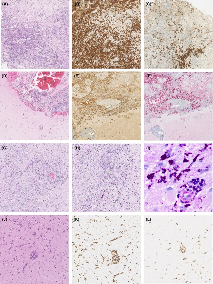 Open Brain Biopsy — Figure 3